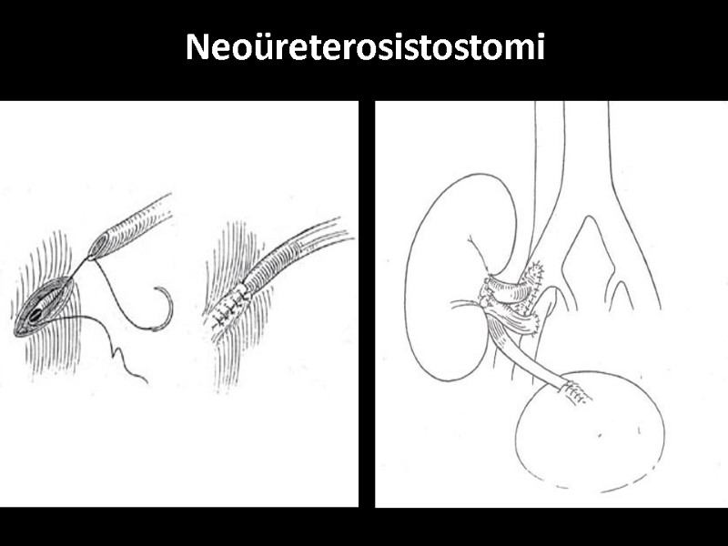 Neoüreterosistostomi